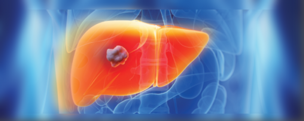 The threat of liver cancer remains despite successful HCV treatment